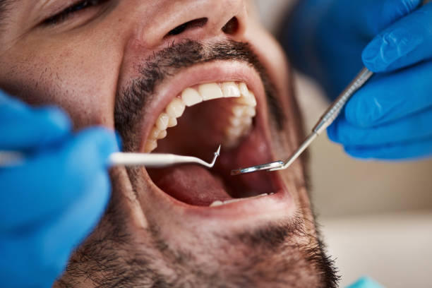 Best Emergency Treatment for Dental Infections or Abscesses in Gateway, FL